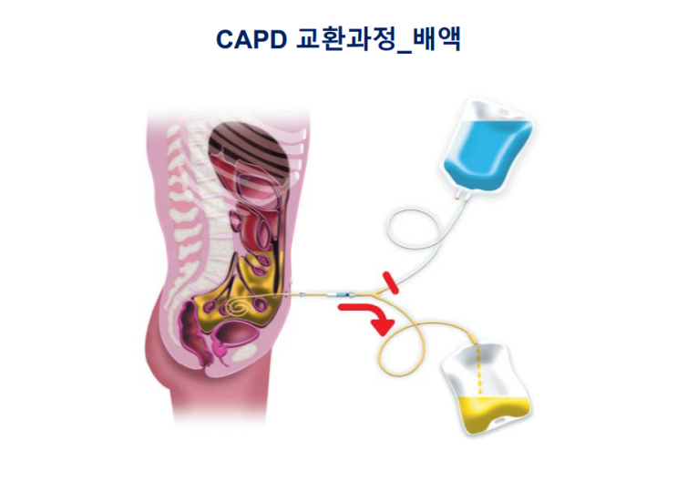  복막투석-(2)복막투석법