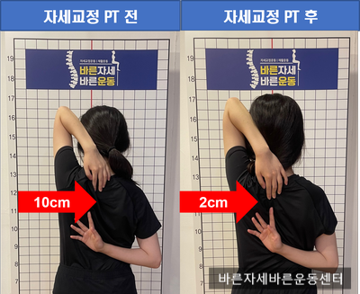  [서래마을PT] 어깨가동범위 바른자세Before&After