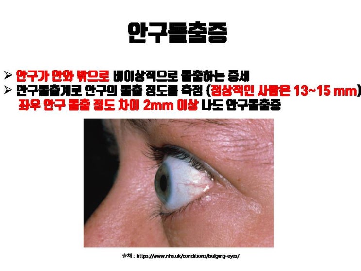  돌출눈은 쌍수하면 대박날 눈인가요 아니면 망하는 눈인가요?