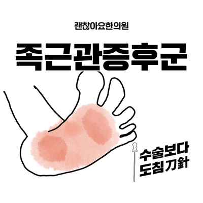  족근관증후군, 경골신경포착