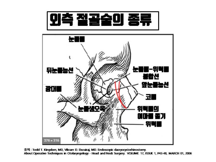  넓은 코, 휜 코 교정에 필수인 코절골술. 성형외과 전문의가 아닌 분들에게 수술 받으면 이런 재앙 같은 부작용이!!!