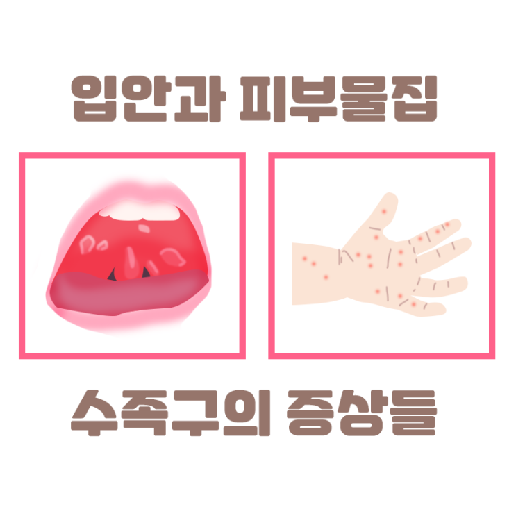  [창원마산 척추관절 디스크 365병원] 아기들의 건강을 위협하는 수족구병