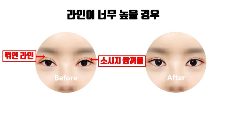  쌍수재수술라인낮추기, 쌍꺼풀두줄따기 절대로 매몰쌍수로 안돼요!!!