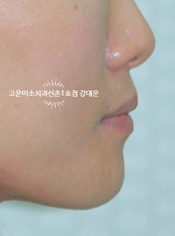  돌출 없으나 덧니 약간 있는 경우 [교정]연세고운미소치과 신촌1호점