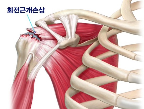  회전근개파열｜어깨통증, 방치하면 더 악화된다.