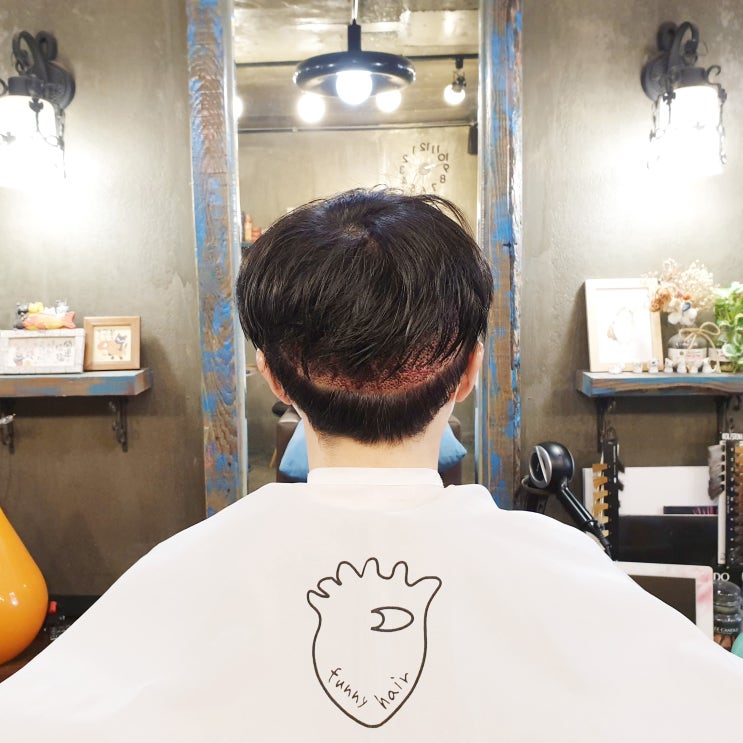  m자 탈모 초기 머리 심기로 해결했어요