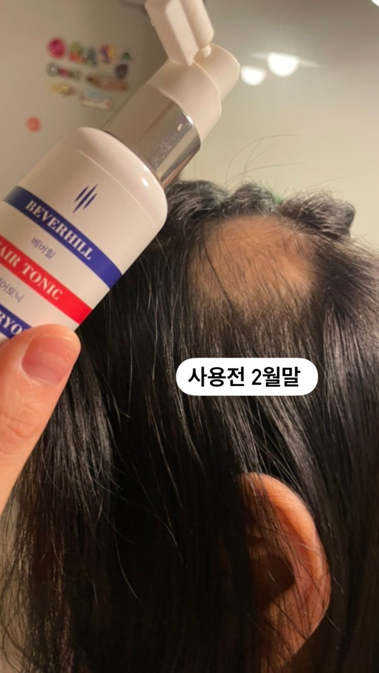  탈모도 탈모인데.. 두피온도? 두피에도 모발 주기가 있는거 아세요? 원형탈모 극복기️