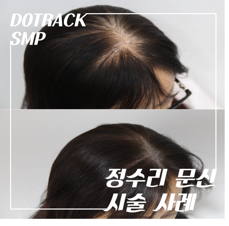  SMP두피문신 하고 밝은 색으로 염색? 흰머리? 어떡하죠?