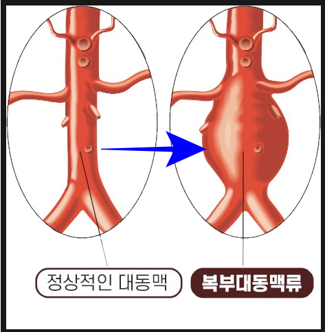    대동맥류 [징후 자가진단법]