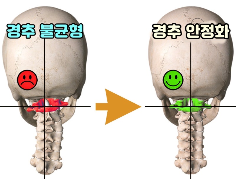 뒤통수통증 왼쪽 오른쪽, 머리무거움