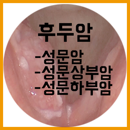  [목] 후두암- 성문암, 성문 상부암, 성문 하부암