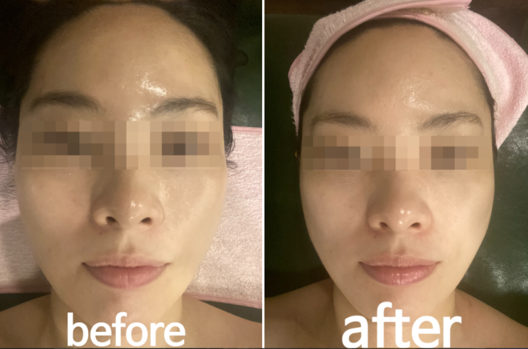 이수역피부관리 골드맘에서 피부관리 받았어요~ 이수역피부관리 골드맘에서 피부관리 받았어요~