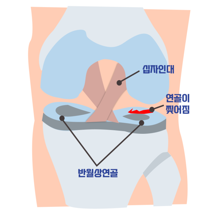  [창원마산 척추관절 디스크 365병원] 반월상 연골 파열