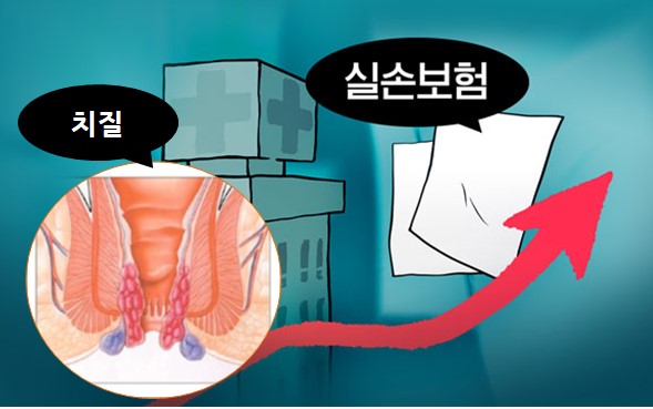  치질 (항문 질환) 수술과 보험. (실손보험)