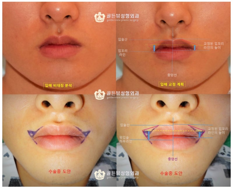 작은입술커지는방법 / 입술가로길이확장술 남자입꼬리수술 89개월차 수술전후분석 : 네이버 블로그