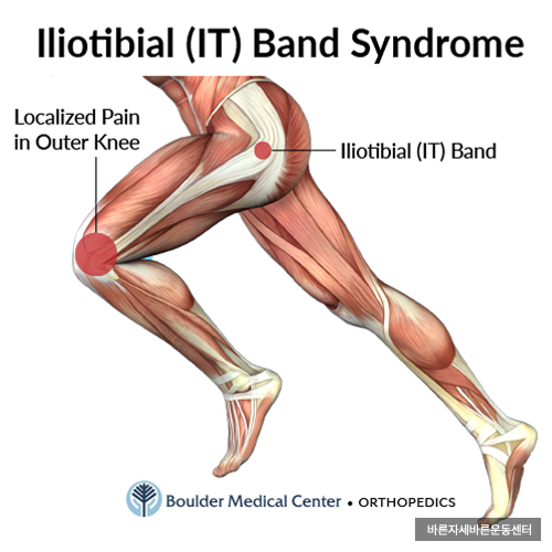  [서래마을 PT] 장경인대증후군(IT-band syndrome pain)
