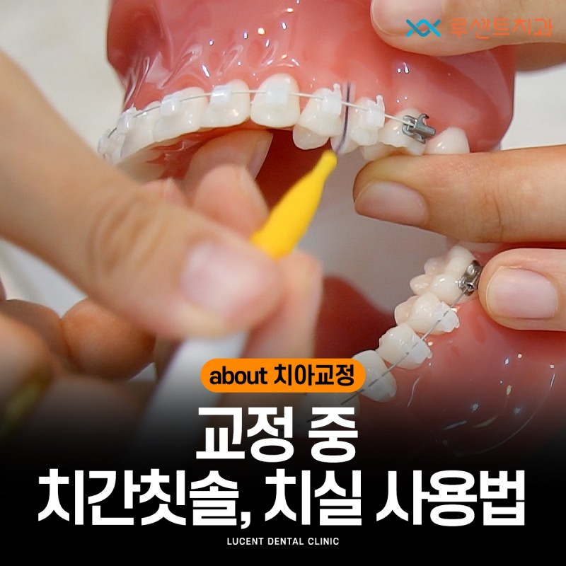 교정중 치간칫솔, 치실 사용법 : 네이버 블로그