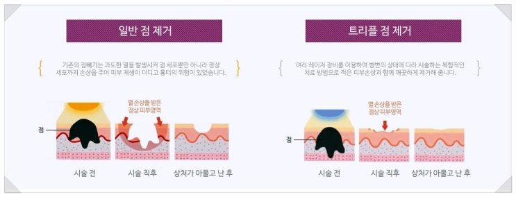  인천점빼기? 부평역 피부과 의사가 말하는 시술 전 주의사항