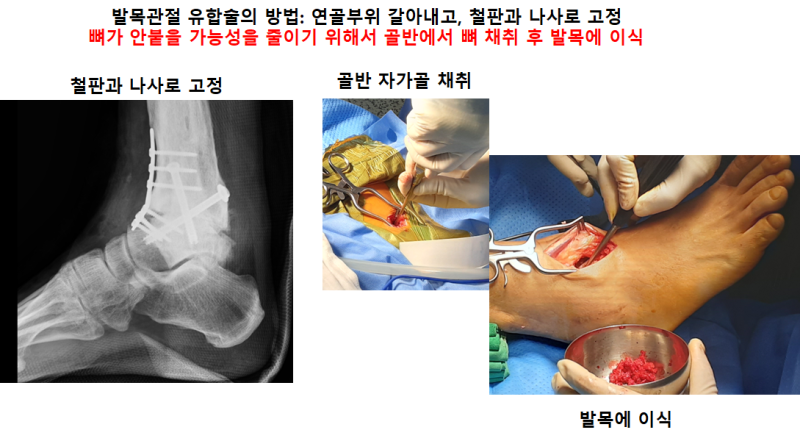 발목의 개방성 골절의 수술적 13