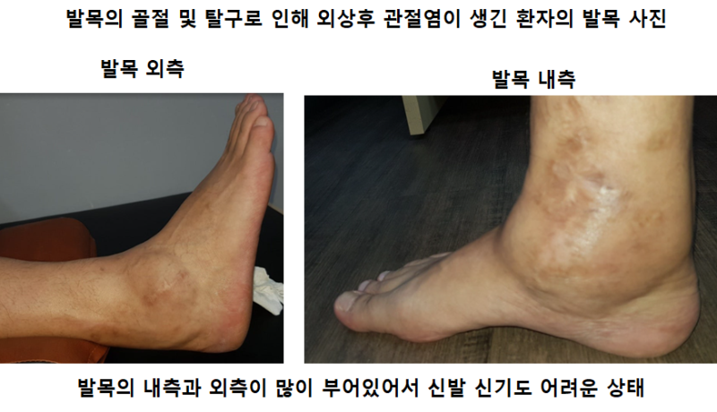 발목의 개방성 골절의 수술적 10