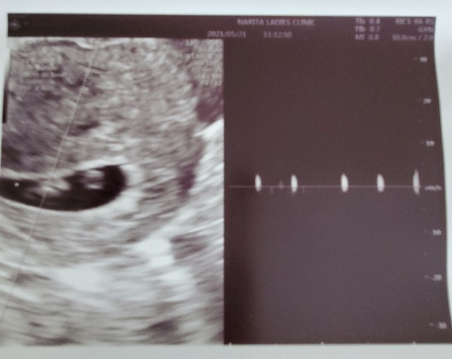 임신 7주,8주 아기집모양 초음파 심장소리 임산부비염