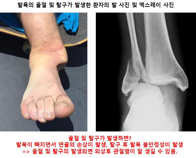 발목의 개방성 골절의 수술적 2