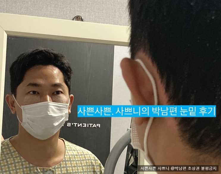  눈밑꺼짐 해결~눈밑지방재배치 수술 후 일주일