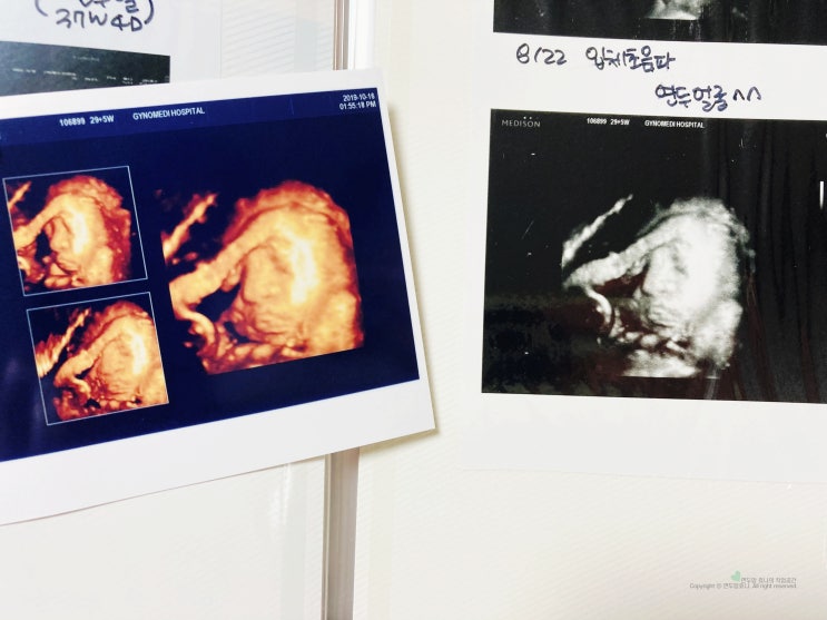 입체초음파 실물 비용 시기 꼭 해야할까? 입체초음파 실물 비용 시기 꼭 해야할까?