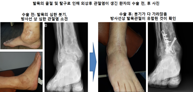 발목의 개방성 골절의 수술적 5