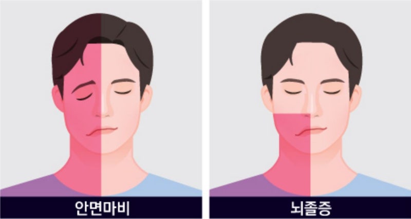 안면마비병원 초기 증상과 후유증 알아보기 10