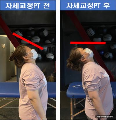 [서래마을 PT] 목 디스크, 어깨 통증 10회만에 통증 사라졌다! (비포&애프터)