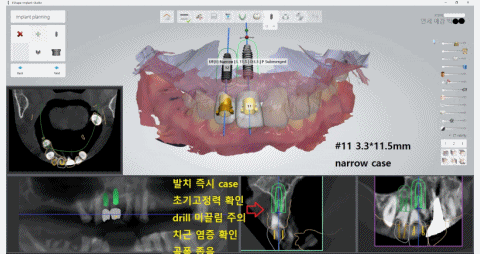  [남대문] 치과임플란트 조금더 덜아프고, 간단하게!