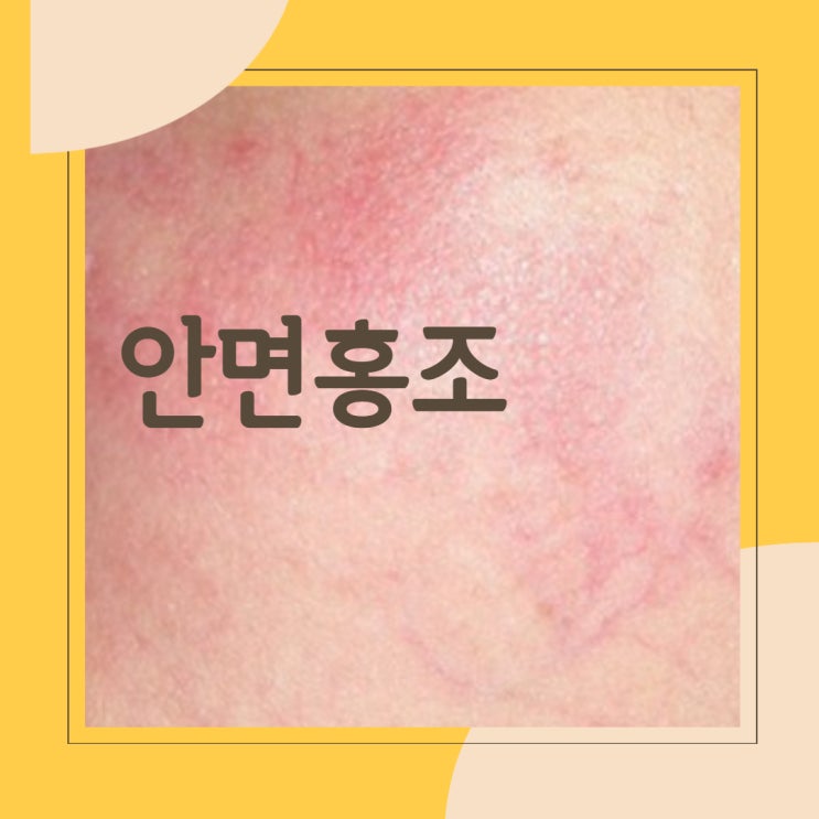  안면홍조 홍반 차이점 원인 증상 치료 아토피 갱년기