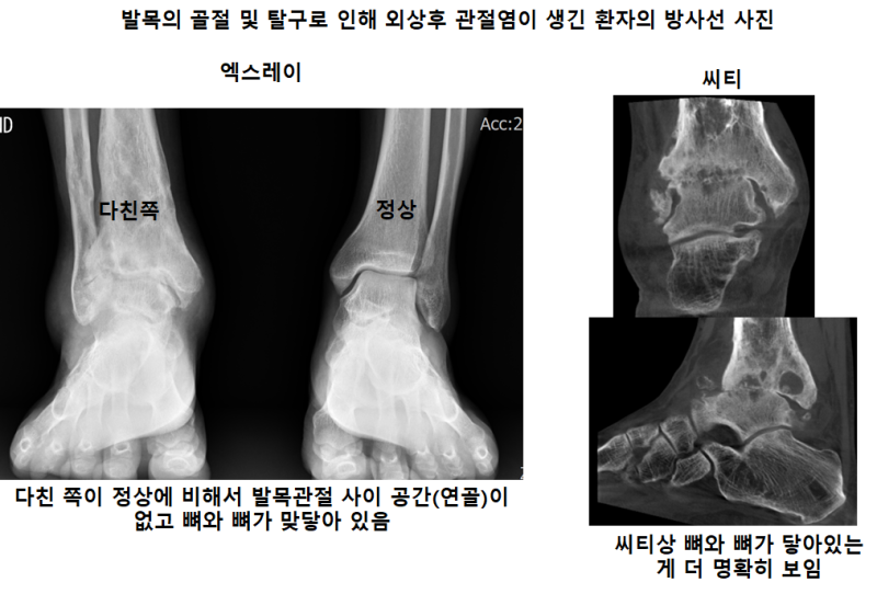 발목의 개방성 골절의 수술적 6