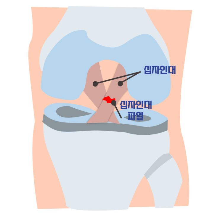  [창원마산 척추관절 디스크 365병원] 십자인대 파열