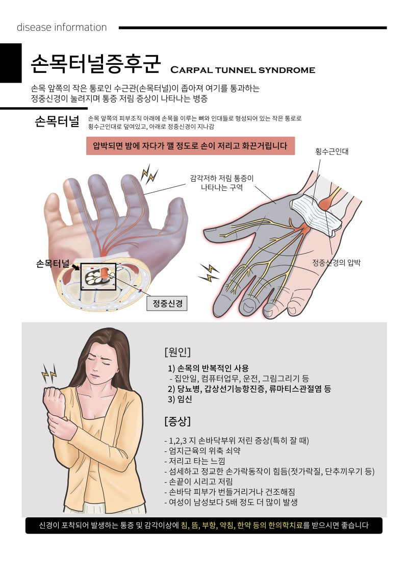 하단한의원 - 손목터널증후군 (정중신경포착)