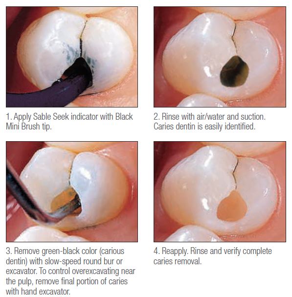  충치 식별액 / 충치 염색액 / caries detector / 충치 확인 / 충치 진단 (응암동 치과)