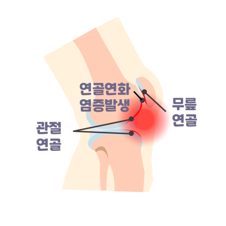  [창원마산 척추관절 디스크 365병원] 연골연화증