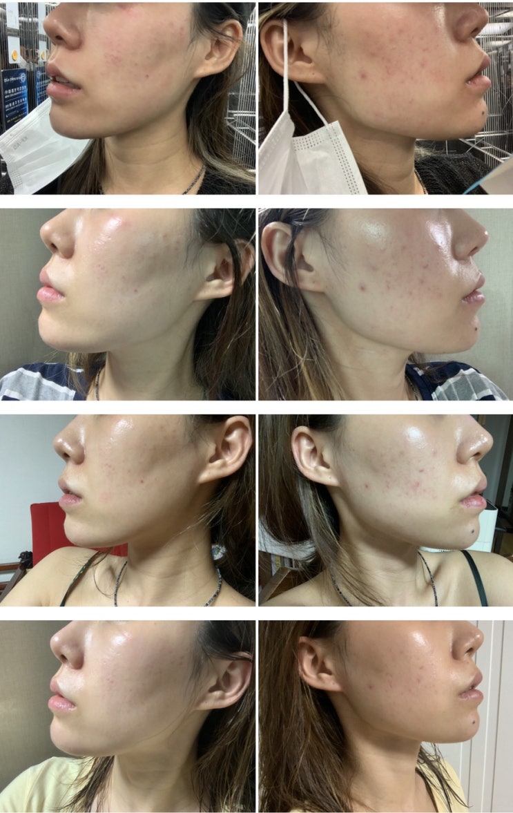  광화문피부과 잡티제거 시너지, VRM토닝 레이저 1회차 후기