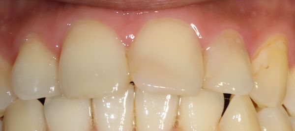 치아옆면 충치치료 과정 (응암동 치과)