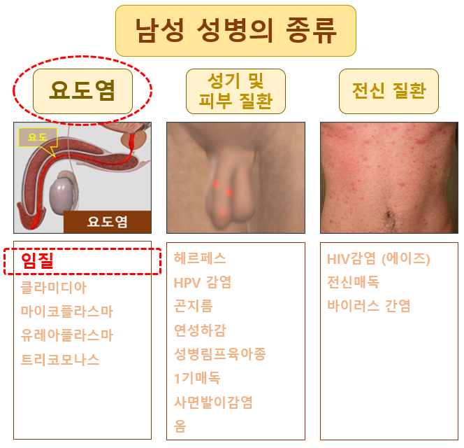 남자 임질 증상, 원인, 검사, 치료 : 네이버 블로그 남자 임질 증상, 원인, 검사, 치료 : 네이버 블로그