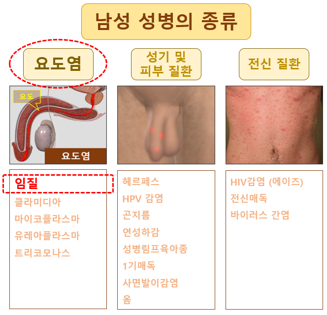 남자 임질 증상, 원인, 검사, 치료 : 네이버 블로그