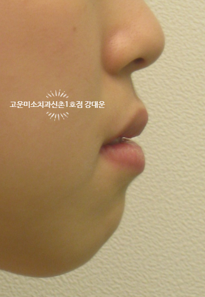  [성인교정] 덧니, 돌출 그리고 잇몸관리