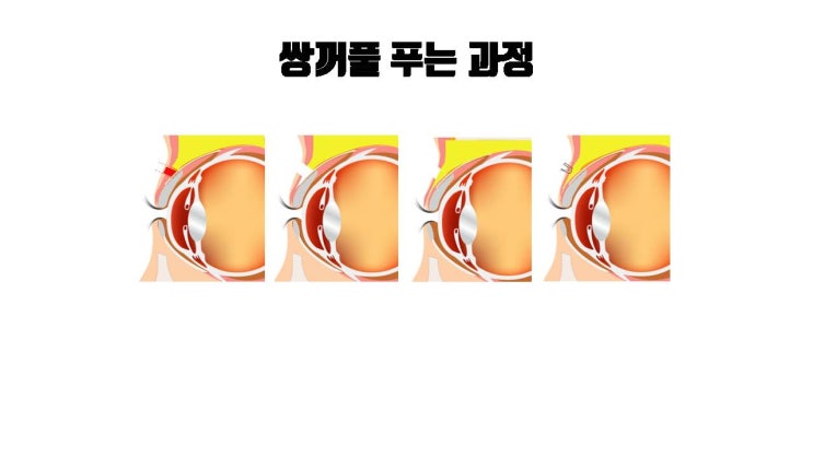  쌍꺼풀 푸는 수술, 쌍꺼풀 풀기 부작용 제대로 알고 쌍수 결정!!!