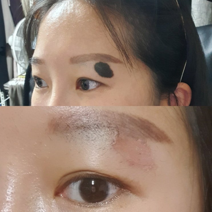  점제거 수술 후 화장 ? 비용 ? 찐 후기 광고아님