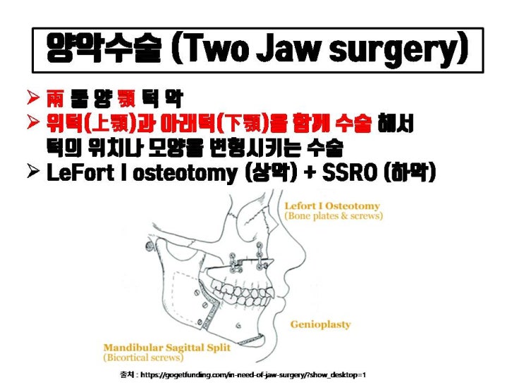  코수술 후 양악 수술을 하게 되면 코성형 모양에 많은 영향을 줍니다!!!