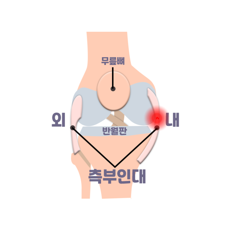  [창원마산 척추관절 디스크 365병원] 내외측 측부인대파열