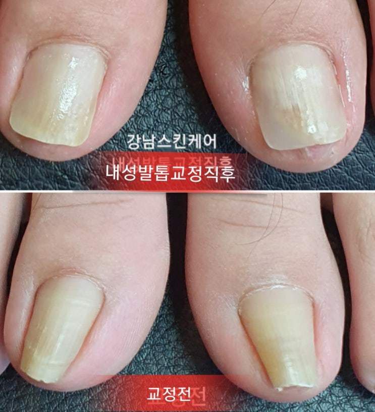  [서귀포시 무좀&내성발톱 교정 네일샵 할인혜택정보]최대 55% 즉시할인! 서귀포제1청사 서귀동!