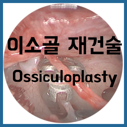  [귀] 이소골 재건술(Ossiculoplasty)