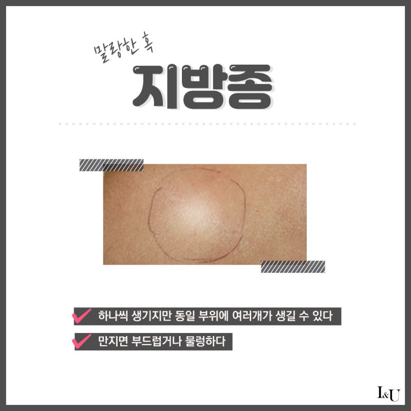 대전피지낭종 낭종이 궁금하세요?